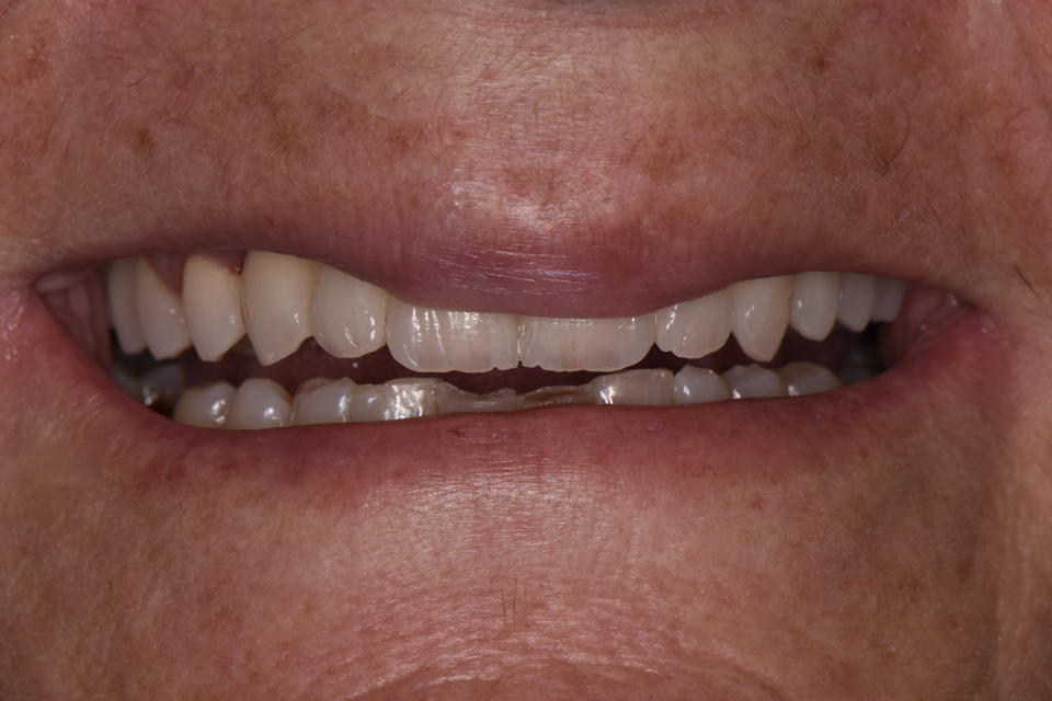 Clinical photograph after