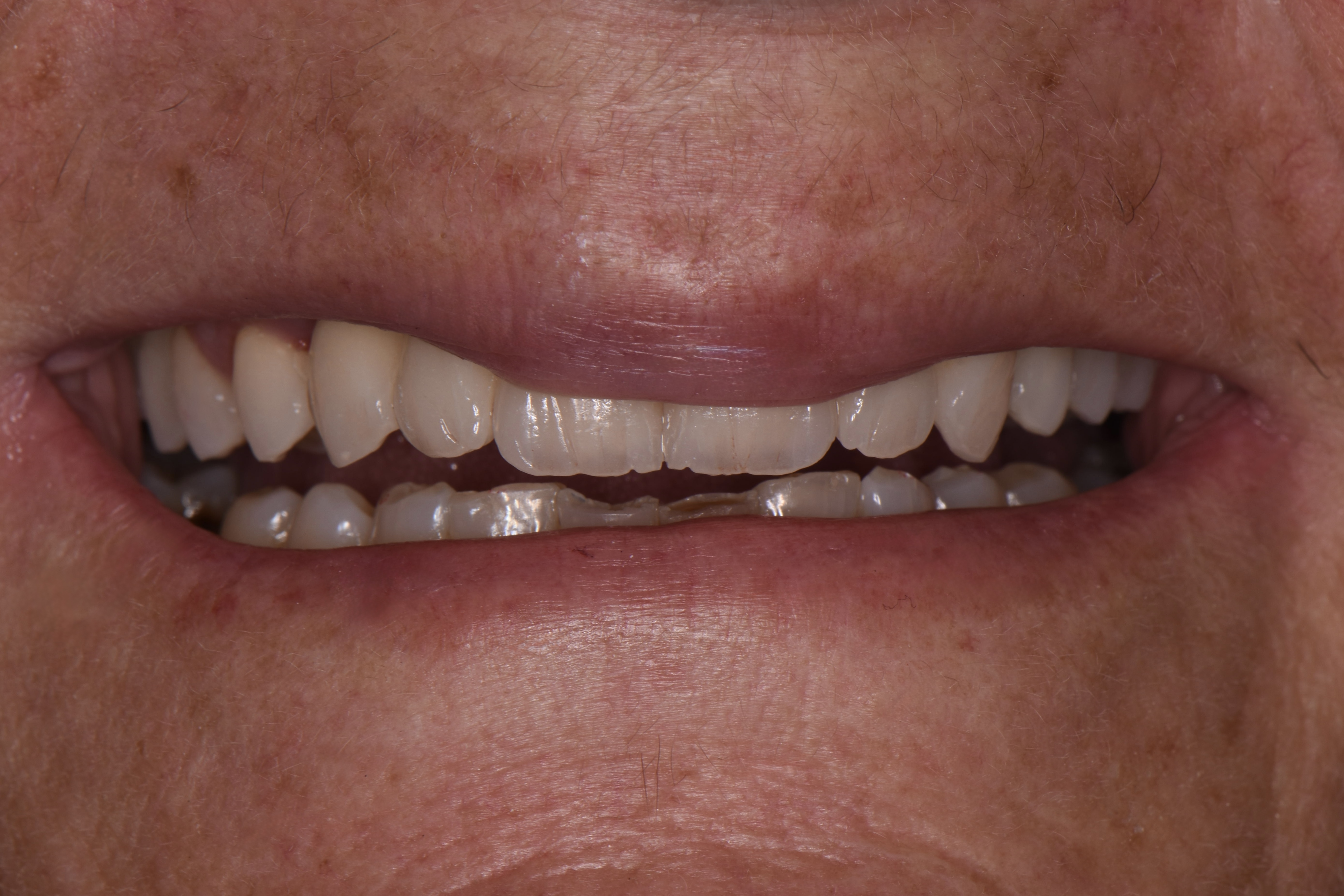 Clinical photograph after
